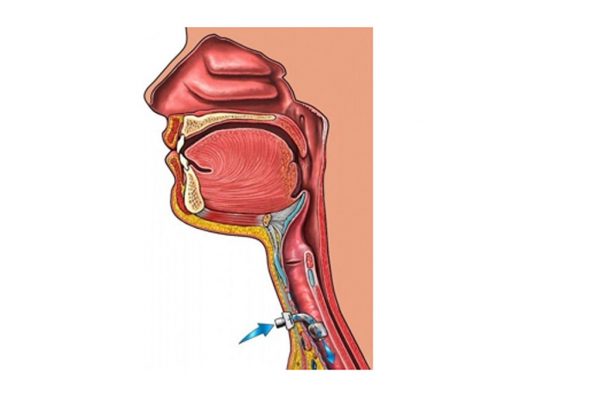 За хората с трахеотомия