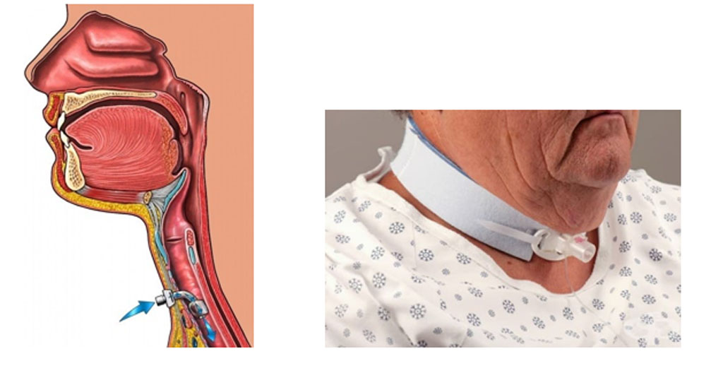 Анатомия на трахеостомата и пациент с трахеостома